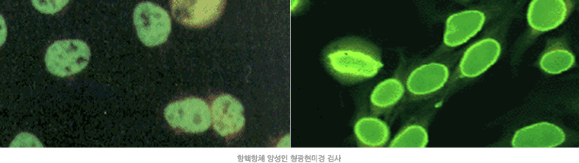 항핵항체 양성인 형광현미경 검사