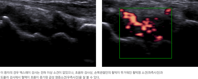 이 환자의 경우 엑스레이 검사는 전혀 이상 소견이 없었으나, 초음파 검사상, 손목관절안의 활막이 뚜거워진 활막염 소견(좌측사진)과 도플러 검사에서 혈액이 흐름이 증가된 급성 염증소견(우측사진)을 잘 볼 수 있다.