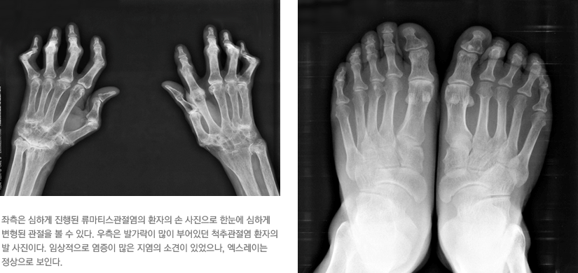 좌측은 심하게 진행된 류마티스관절염의 환자의 손 사진으로 한눈에 심하게 변형된 관절을 볼 수 있다. 우측은 발가락이 많이 부어있던 척추관절염 환자의 발 사진이다. 임상적으로 염증이 많은 지염의 소견이 있었으나, 엑스레이는 정상으로 보인다.