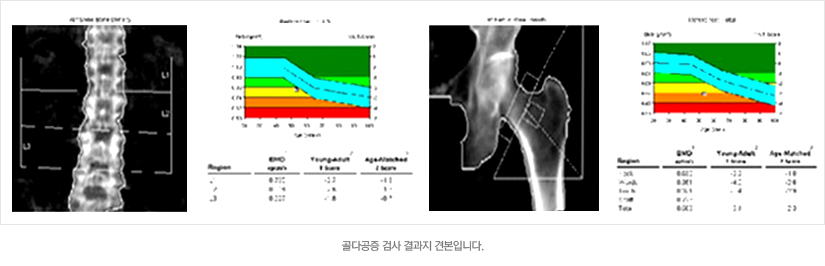 골다공증 검사 결과지 견본입니다.